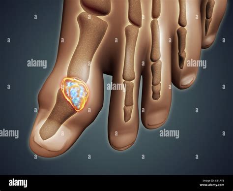 His Foot Swollen With Gout Hi Res Stock Photography And Images Alamy