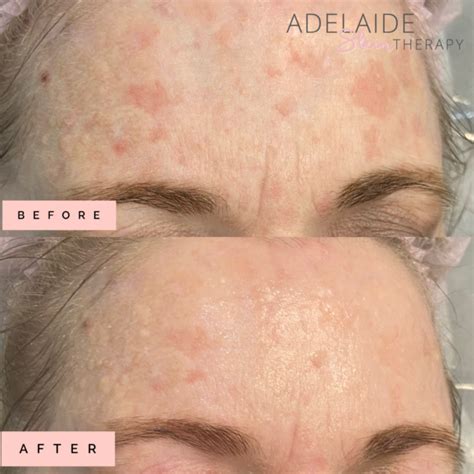 Chemical Peel Adelaide Skin Therapy Malvern Adelaide