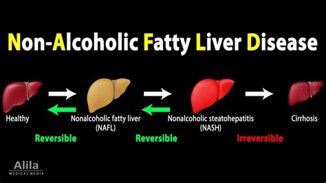 Nonalcoholic Fatty Liver Disease Nafld Animation All About Diabetes