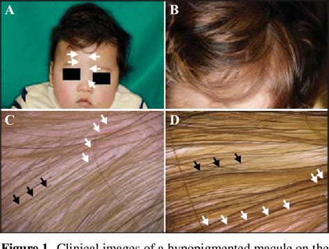 Figure 1 From Nevus Depigmentosus With Yellow Hair Colour Due To An