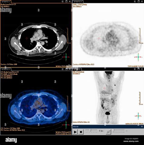 A Composite Positron Set Of Emission Tomography Pet Scan Images Of