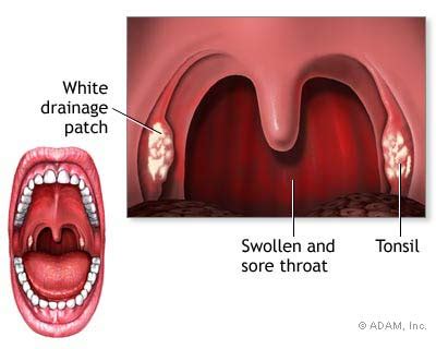 Strep Throat Symptoms Diagnosis Treatment Of Strep Throat NY