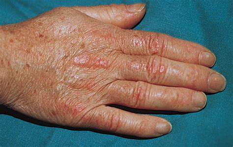 Amyopathic Dermatomyositis A Review By The Italian Group Of