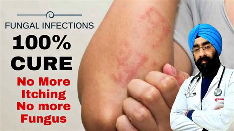 Best Treatment Of Fungal Skin Infections Expert Advice Dreducation