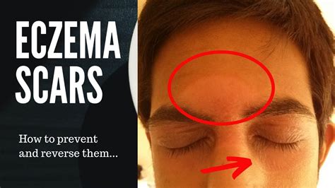 Eczema Scars How To Preventreverse Eczema Scars Youtube