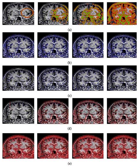 A Shows The Segmentation Results Using The Active Contour Method