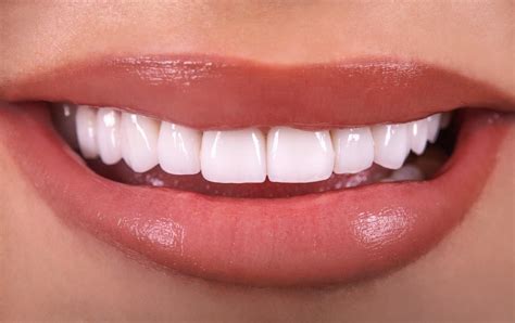 porcelain veneers the pros and cons