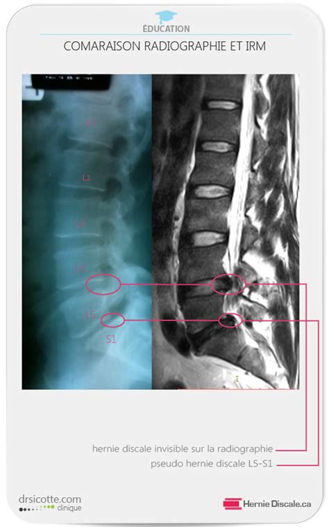 Sympt Mes Hernie Discale Lombaire