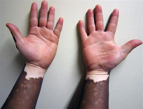 Vitiligo Dermatology Medbullets Step 1