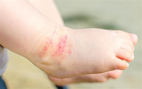 Pre School Plan Eczema On Toddlers Feet