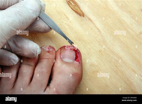 Surgery On A Broken Bleeding Toe Nail A Man Stock Photo Alamy