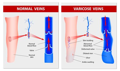 Function Of Venous Valves