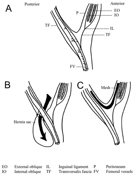 Bilateral Retrovascular Femoral Hernia The Annals Of The Royal