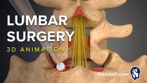 Lumbar Surgery Laminectomy 3d Medical Animation Youtube