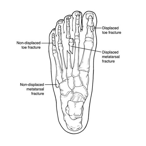 Toe And Metatarsal Fractures Sun Valley Foot And Ankle