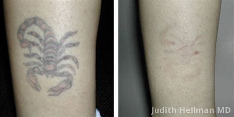 Your treated area will be covered by the dressing after the treatment for several days. Tattoo Removal Before & After Photos NYC