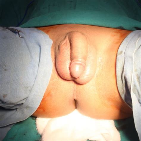 Phalloplasty Pics Transsexual Surgery Images