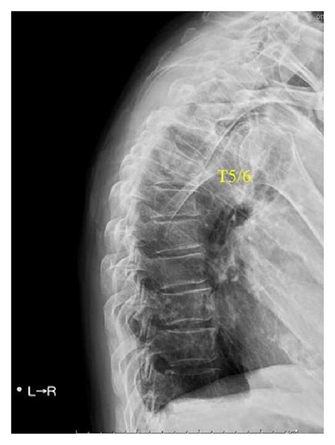 A Anteroposterior And B Lateral Radiographs Of The Thoracic Spine
