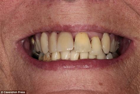 Preston Woman Wins £35k After Losing 13 Teeth Following Botched Dental