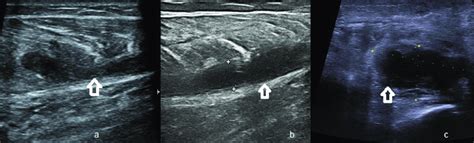 A C Lower Limbs Ultrasound Images In Grey Scale Showing Three