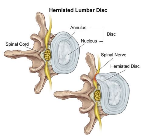 Lumbar Disc Disease Legacy Spine And Neurological Specialists