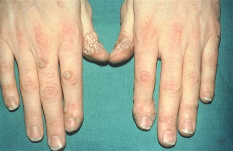Types Of Warts And How To Treat Them A Visual Guide Allure