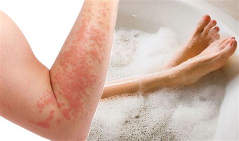 Types Of Eczema Commonly Found In Older Adults Plus Treatment Porn