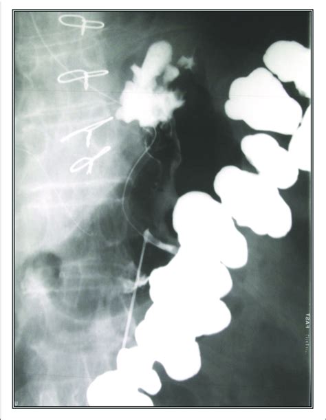 Percutaneous Radiological Gastrostomy Tube Insertion Download