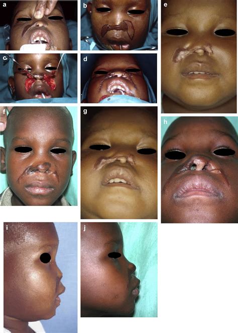 A Preoperative View At 3 Years Of Age Showing The Nostril Stenosis