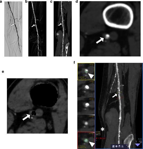 Dual Energy Ct Angiography In Peripheral Arterial Occlusive Disease