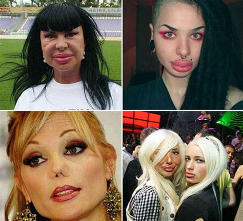 31 Plastic Surgery Gone Wrong Pictures That Will Make You Feel