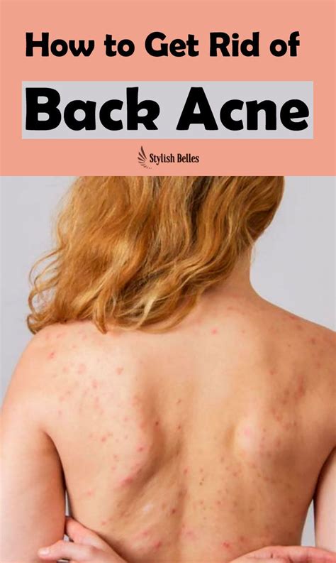How To Get Rid Of Back Acne Stylish Belles Acne How To Get Rid Rid