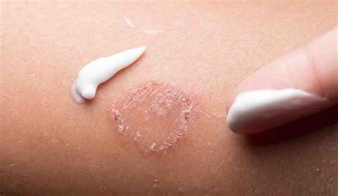 Do These Measures To Prevent Skin Infections That Increase In Cold