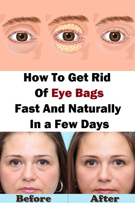 How To Get Rid Of Eye Bags Fast And Naturally In A Few Daysbeauty
