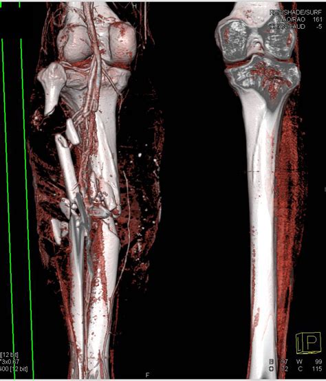 Gunshot Wound To Lower Leg With Soft Tissue And Bone Trauma And