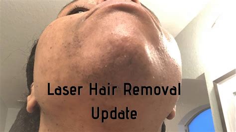 Has Laser Hair Removal Worked Dark Skin Yag Laser Youtube