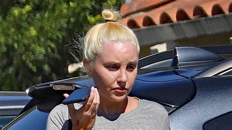 Amanda Bynes Appears To Be Getting Heart Shaped Face Tattoo Removed As She Displays Noticeably