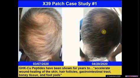 Hair Restoration Before And After 6 Weeks With Lifewave X39 Patches Dr