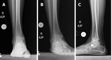 Distraction Arthroplasty In Osteoarthritis Of The Foot And Ankle