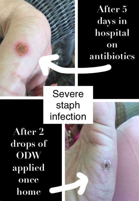 Pictures Of Healing Staph Infection Picturemeta
