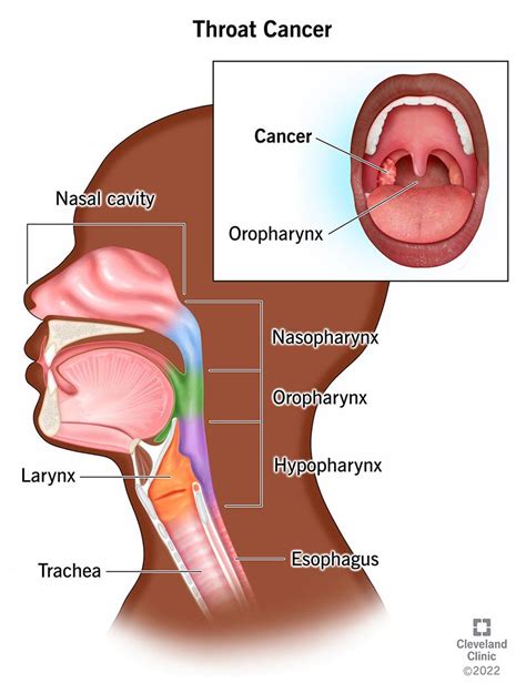 Throat Cancer Symptoms Signs Causes Prognosis