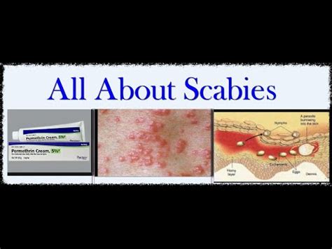 Everything You Need To Know About Scabies Youtube
