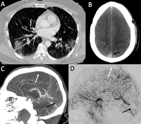Acute Onset Of Cerebral Venous Thrombosis In Multiple Locations In Man