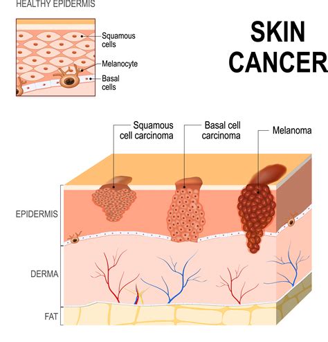 Skin Cancer Cells Illustration Fairfield Medical Center