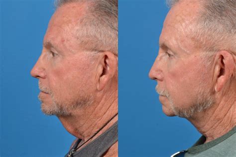 Patient 122406564 Profile Neck Lift Before And After Photos Clevens