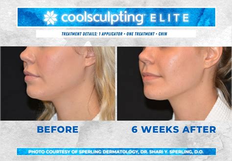 Submental Fat Coolsculpting Before And After Patient 10 Sperling