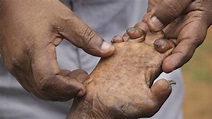 How to bring an end to disabilities among children with leprosy