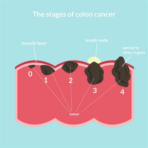 Colon Cancer Stages Symptoms