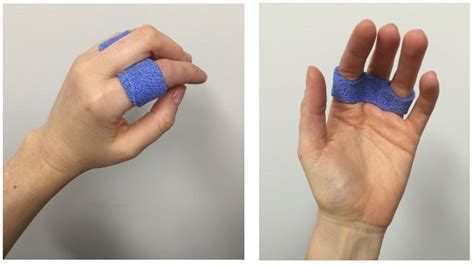 Splinting With Orficast Thermoplastic Tape Orficast Alternatives To