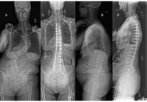 Combined Neurosurgical And Orthopedic Training Facilitates Complex